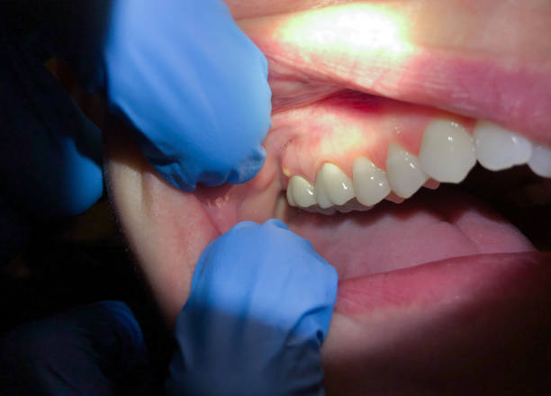 Best Root Canal Emergency Dentist  in Abbeville, LA
